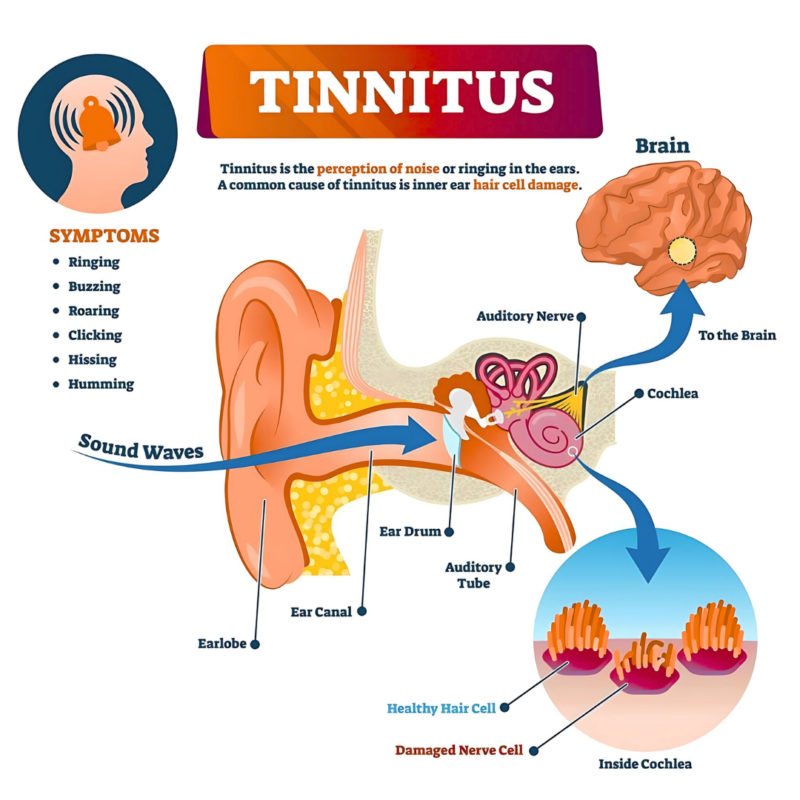 Tinnitus