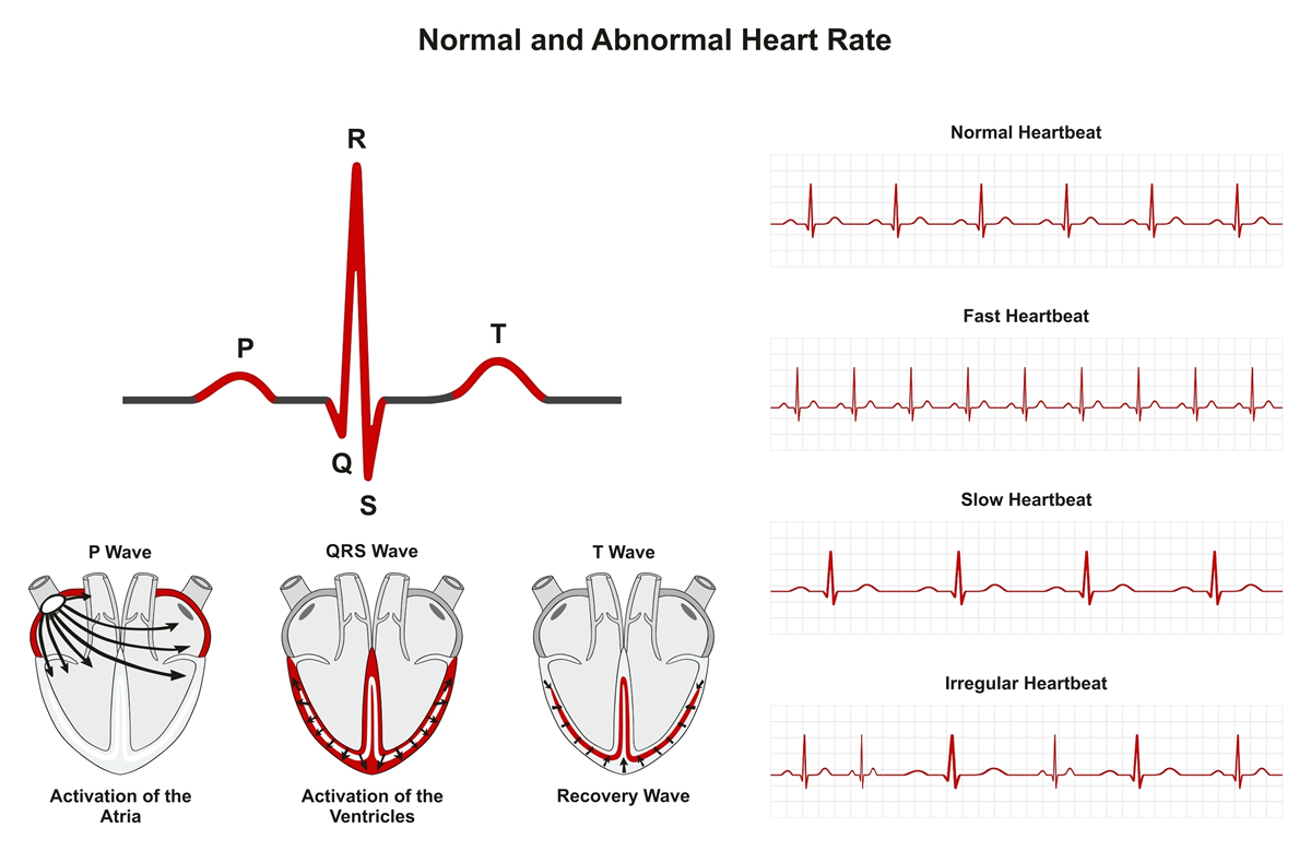 Arrhythmia