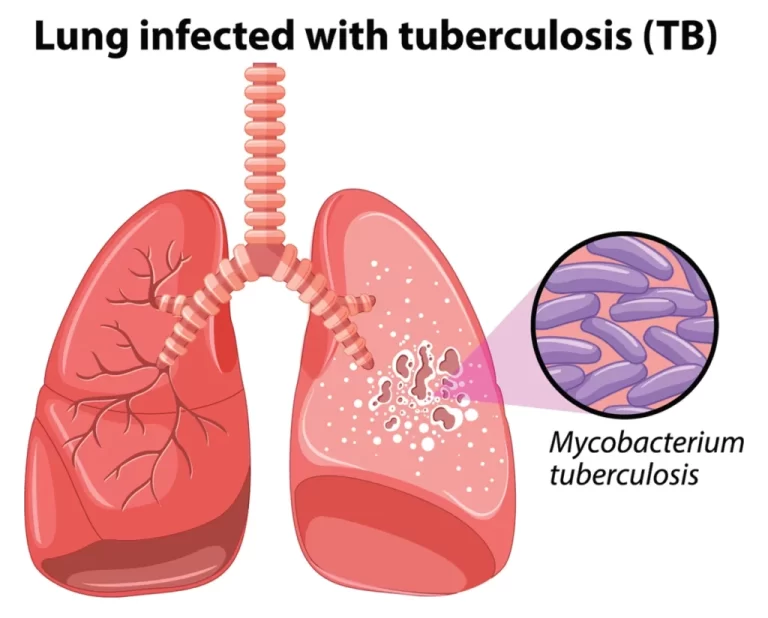 Tuberculosis (TB)