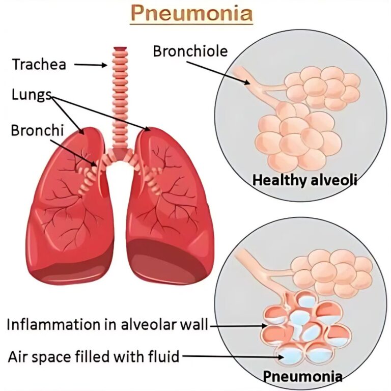 Pneumonia in Children