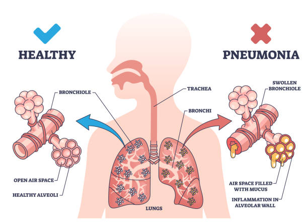 Pneumonia