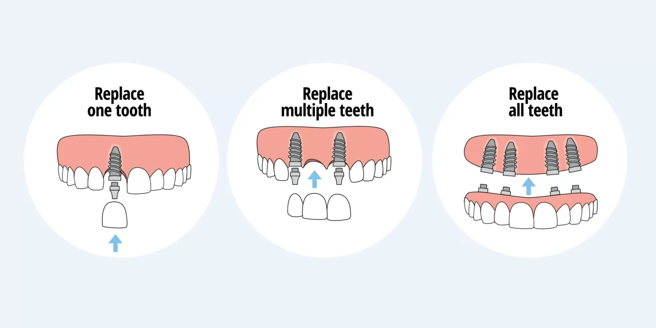 Types of Dental Implants